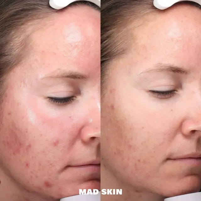 Chemical Peel result at MAD SKIN in Lehi, UT