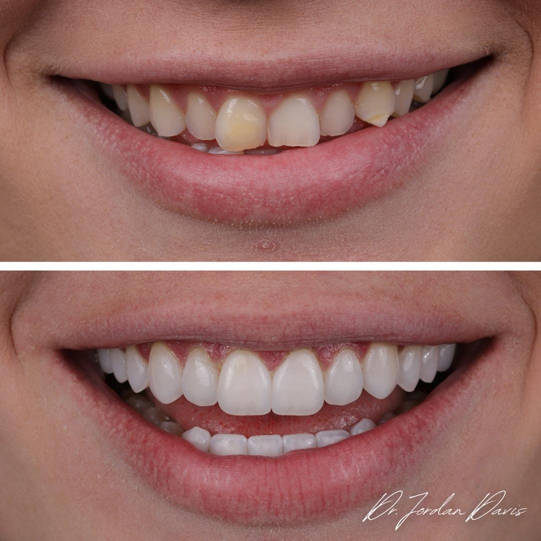Luca Aesthetic veneers result — Woods Cross, UT