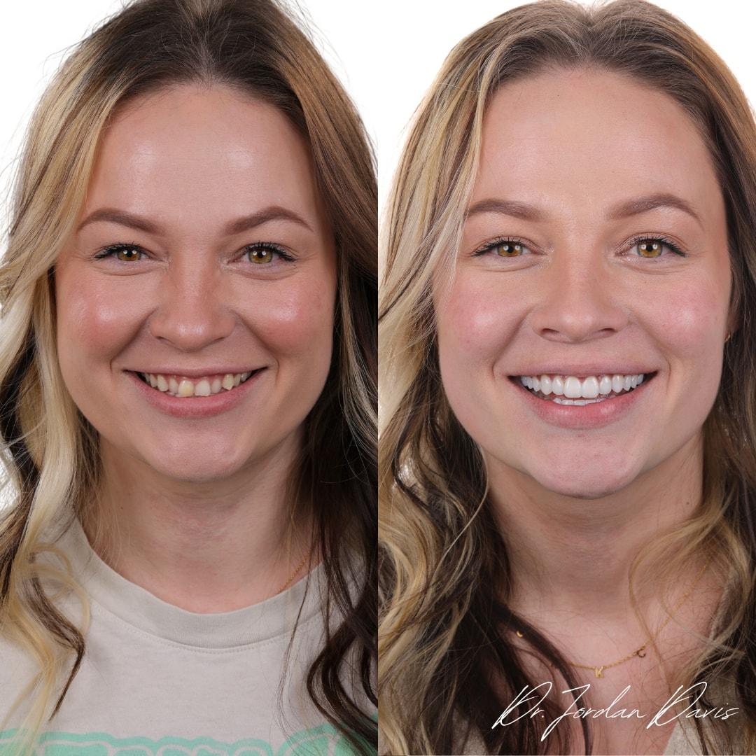 Luca Aesthetic smile makeover result — Woods Cross, UT