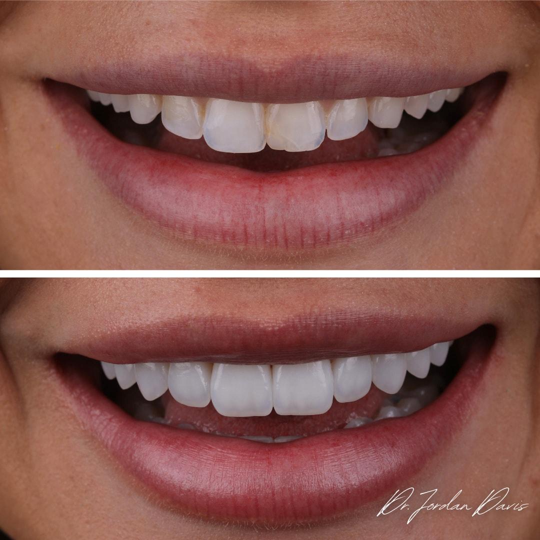 Luca Aesthetic veneers result — Woods Cross, UT