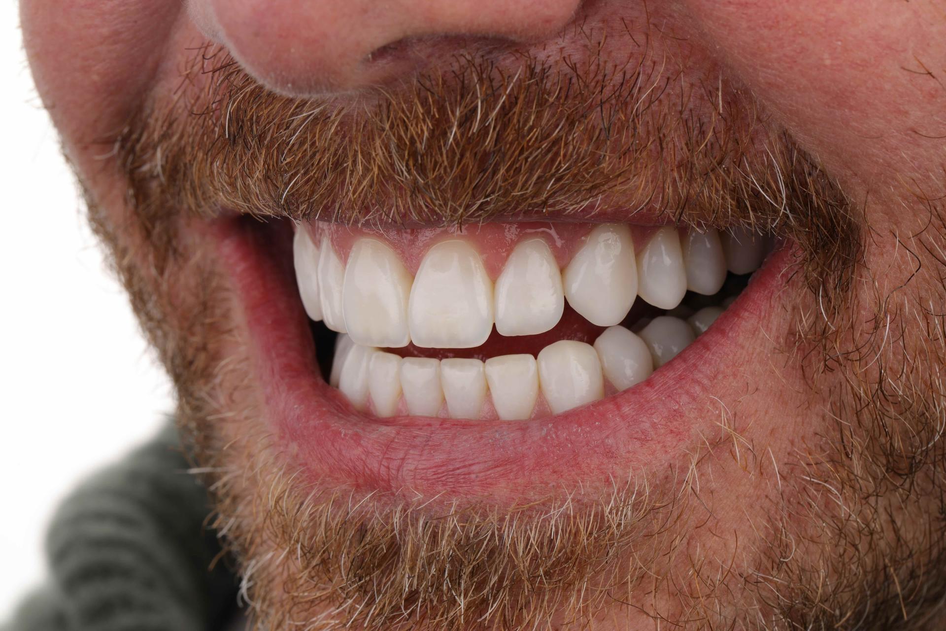 Luca Aesthetic smile makeover after — Woods Cross, UT