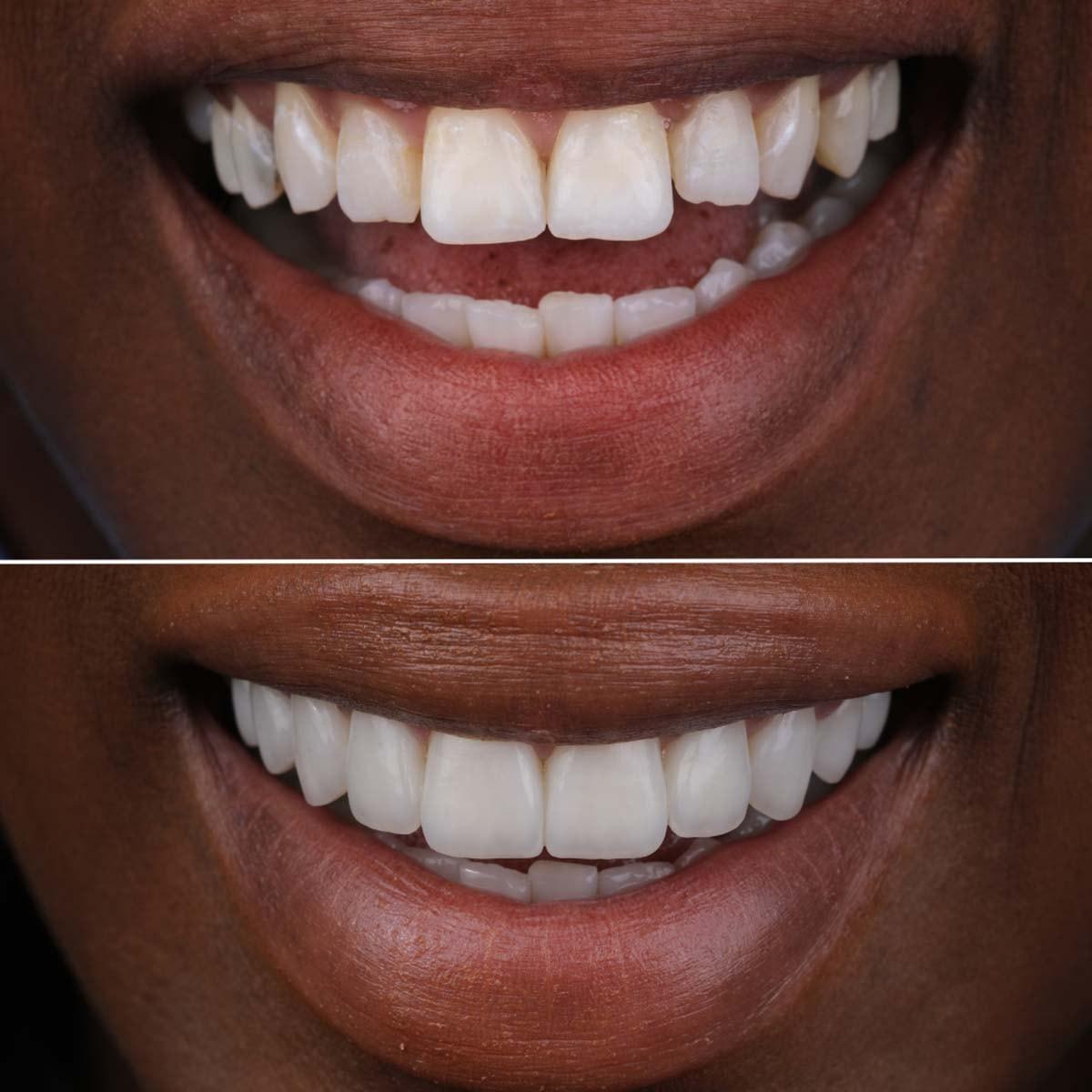 Luca Aesthetic veneers result — Woods Cross, UT