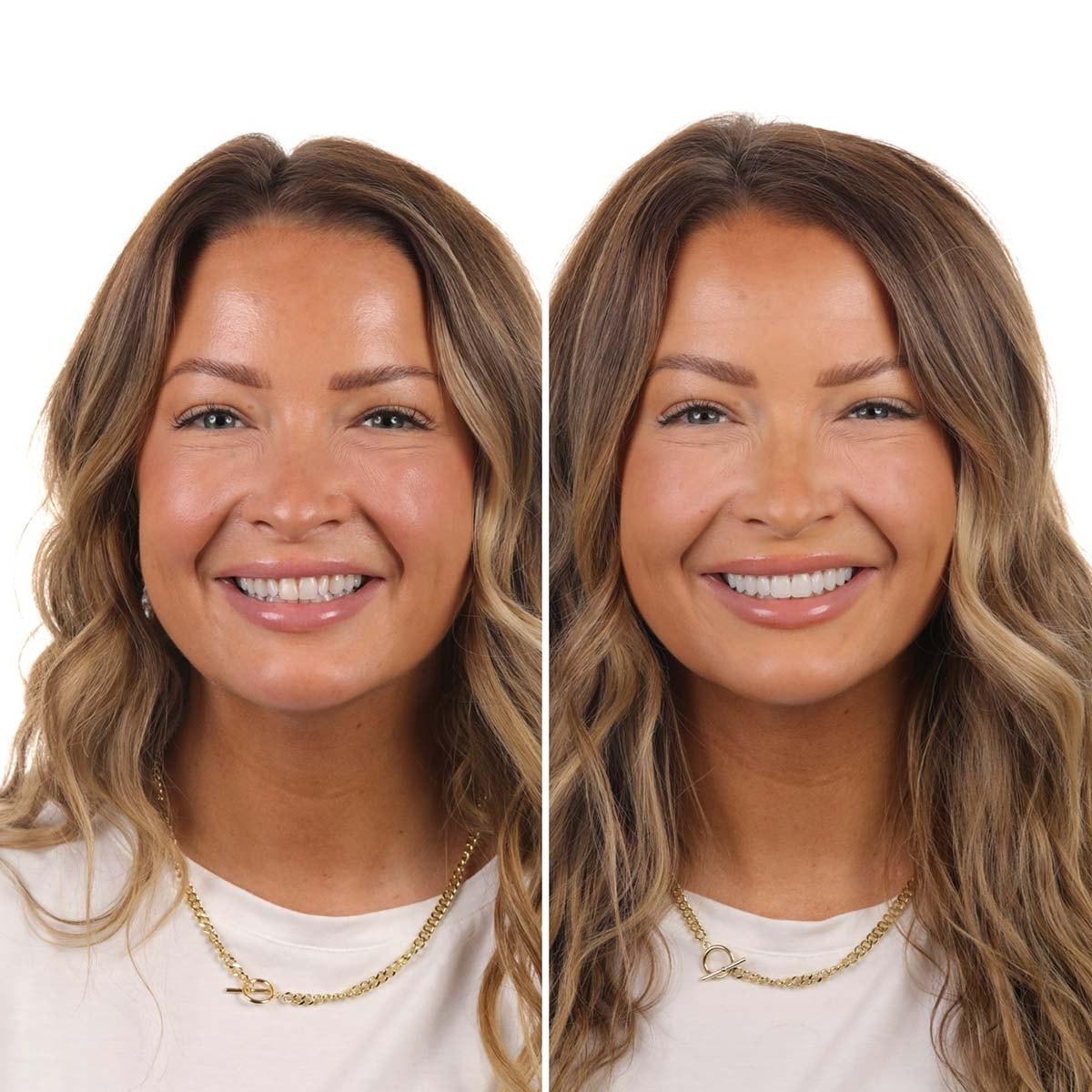 Luca Aesthetic veneers result — Woods Cross, UT