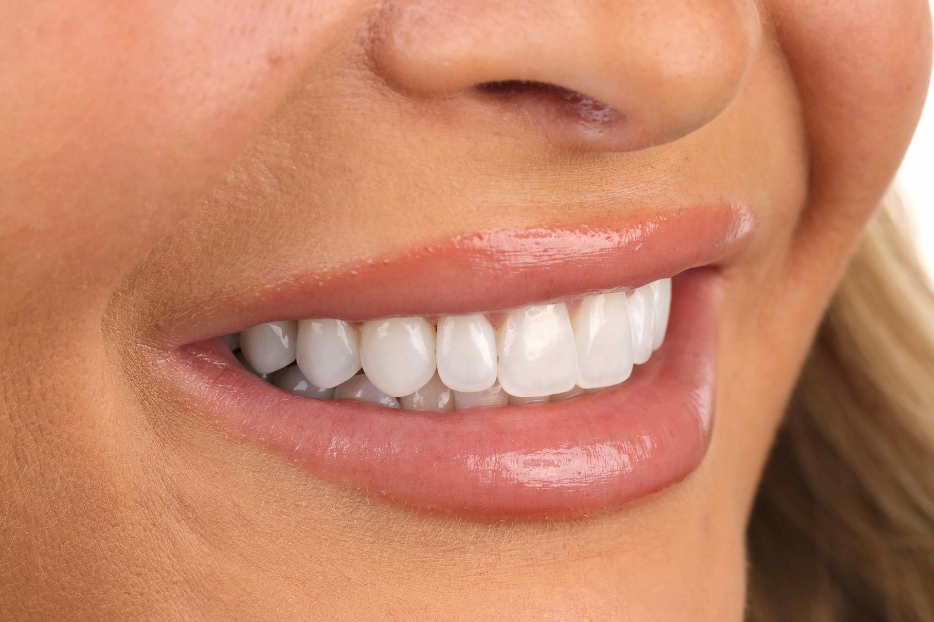 Luca Aesthetic smile makeover after — Woods Cross, UT
