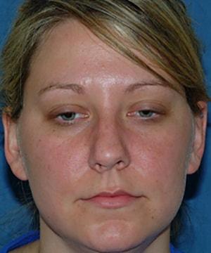 Rhinoplasty before at Chatham Facial Plastic Surgery & Medical Skin Care, Chatham Donn R MD in Louisville, KY