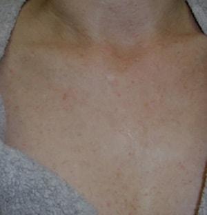 Laser Skin Resurfacing after at Chatham Facial Plastic Surgery & Medical Skin Care, Chatham Donn R MD in Louisville, KY
