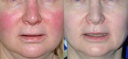Chatham Facial Plastic Surgery & Medical Skin Care, Chatham Donn R MD laser treatment result — St Matthews, KY