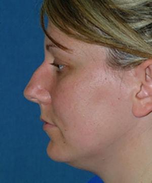 Rhinoplasty before at Chatham Facial Plastic Surgery & Medical Skin Care, Chatham Donn R MD in Louisville, KY