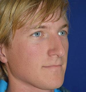 Rhinoplasty before at Chatham Facial Plastic Surgery & Medical Skin Care, Chatham Donn R MD in Louisville, KY
