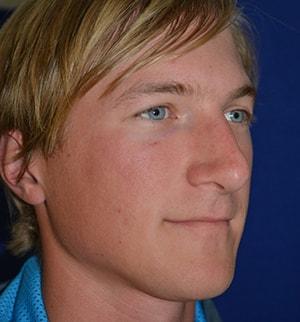 Chatham Facial Plastic Surgery & Medical Skin Care, Chatham Donn R MD rhinoplasty after — Louisville, KY