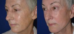 Chatham Facial Plastic Surgery & Medical Skin Care, Chatham Donn R MD result — St Matthews, KY