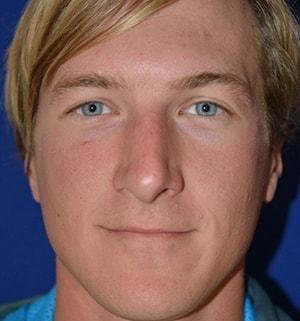 Chatham Facial Plastic Surgery & Medical Skin Care, Chatham Donn R MD rhinoplasty after — Louisville, KY