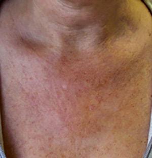 Laser Skin Resurfacing before at Chatham Facial Plastic Surgery & Medical Skin Care, Chatham Donn R MD in Louisville, KY