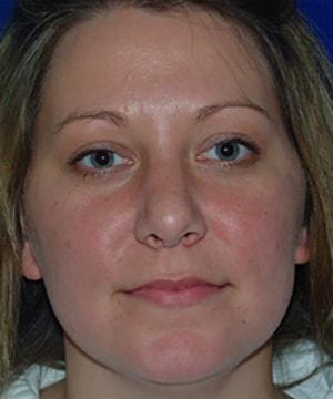 Chatham Facial Plastic Surgery & Medical Skin Care, Chatham Donn R MD rhinoplasty after — Louisville, KY
