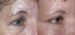 Chatham Facial Plastic Surgery & Medical Skin Care, Chatham Donn R MD blepharoplasty result — Louisville, KY