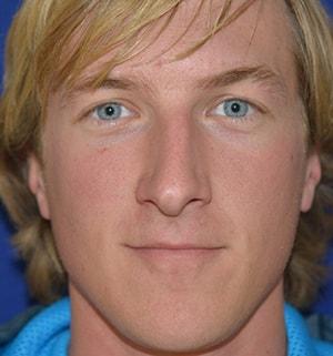 Rhinoplasty before at Chatham Facial Plastic Surgery & Medical Skin Care, Chatham Donn R MD in Louisville, KY
