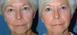 Chatham Facial Plastic Surgery & Medical Skin Care, Chatham Donn R MD facelift result — St Matthews, KY