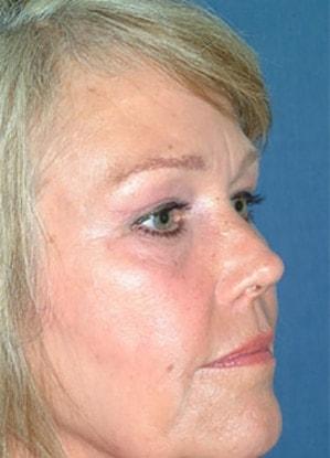 Chatham Facial Plastic Surgery & Medical Skin Care, Chatham Donn R MD blepharoplasty after — Louisville, KY