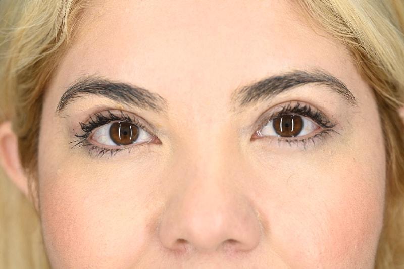 Origins Plastic Surgery eyelid lift after — Houston, TX