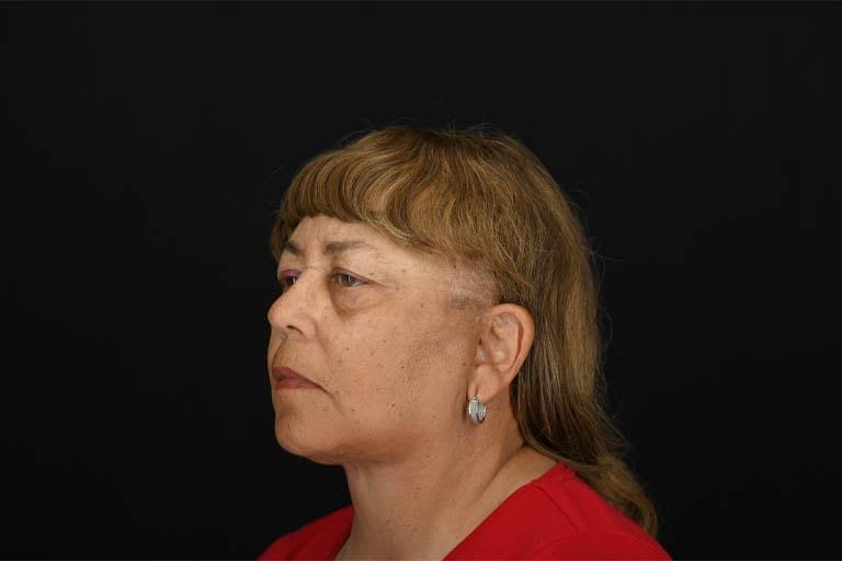 Origins Plastic Surgery facelift after — Houston, TX