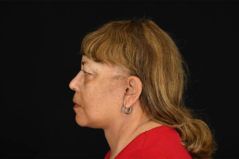 Origins Plastic Surgery facelift after — Houston, TX
