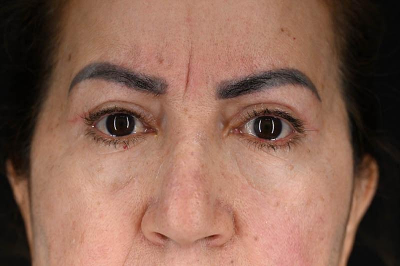 Origins Plastic Surgery eyelid lift after — Houston, TX