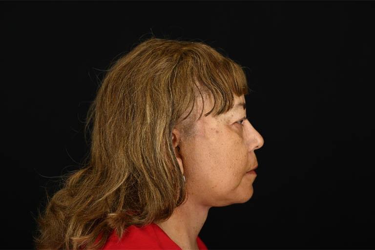 Origins Plastic Surgery facelift after — Houston, TX