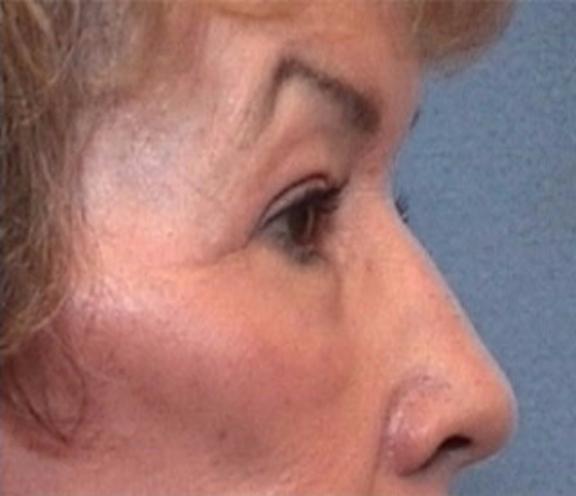 Dr. Diane Duncan blepharoplasty after — Fort Collins, CO