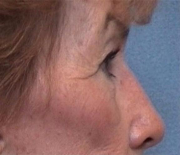 Blepharoplasty before at Dr. Diane Duncan in Fort Collins, CO