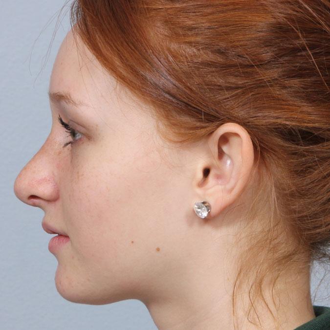 Dr. Diane Duncan rhinoplasty after — Fort Collins, CO