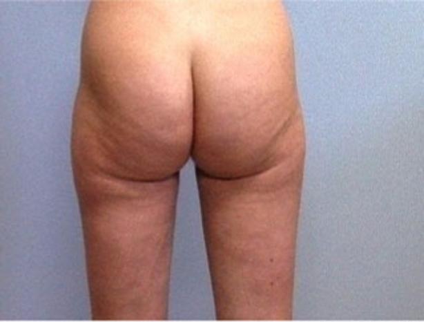 Dr. Diane Duncan liposuction after — Fort Collins, CO