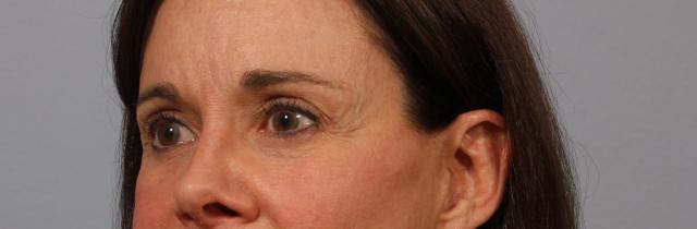 Brow Lift before at Dr. Diane Duncan in Fort Collins, CO