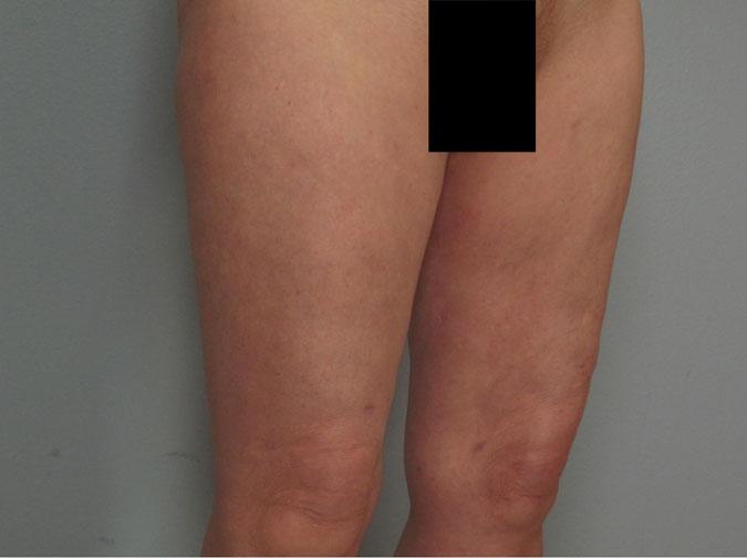 Dr. Diane Duncan liposuction after — Fort Collins, CO