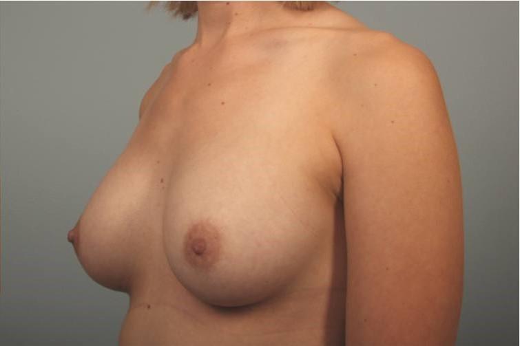Dr. Diane Duncan breast augmentation after — Fort Collins, CO