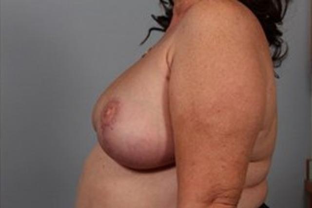 Breast Reduction after at Dr. Diane Duncan in Fort Collins, CO
