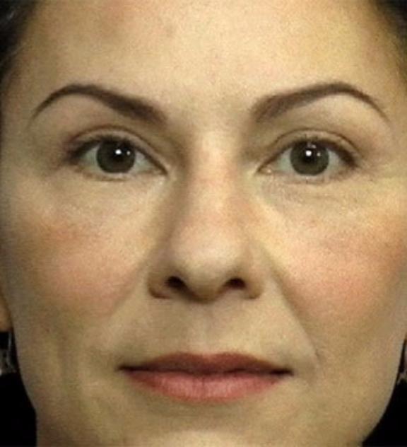 Dr. Diane Duncan blepharoplasty after — Fort Collins, CO