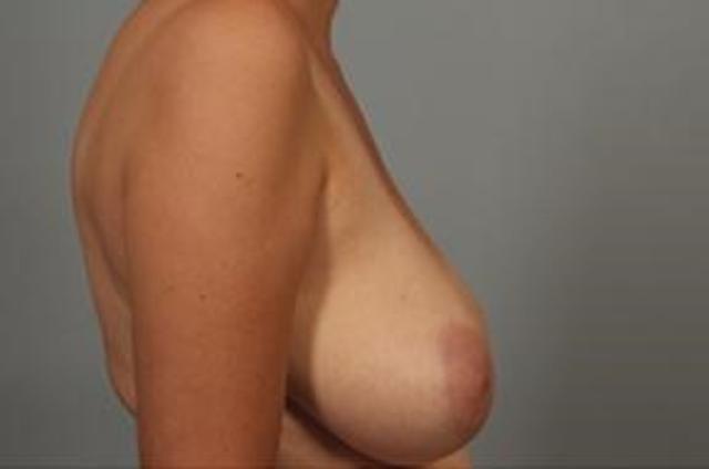 Breast Reduction before at Dr. Diane Duncan in Fort Collins, CO