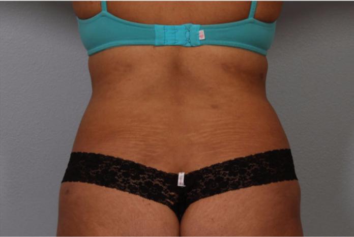 Dr. Diane Duncan liposuction after — Fort Collins, CO