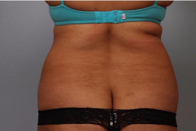 Liposuction before at Dr. Diane Duncan in Fort Collins, CO