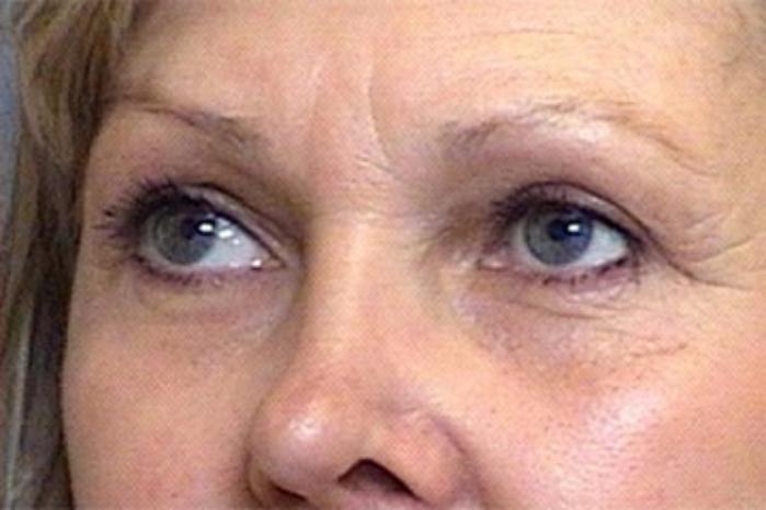 Dr. Diane Duncan blepharoplasty after — Fort Collins, CO