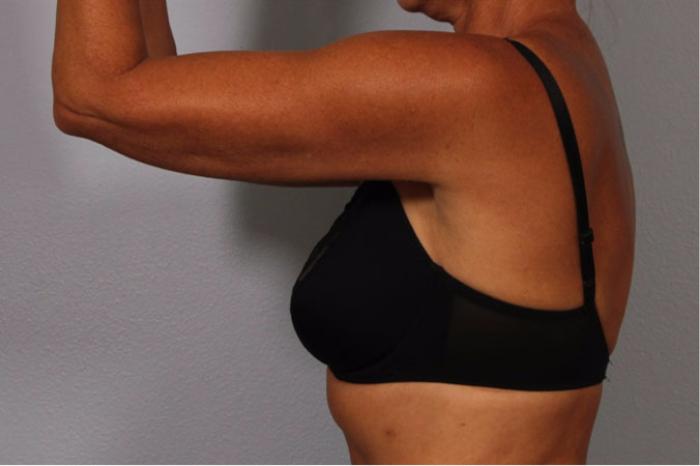 Dr. Diane Duncan arm lift after — Fort Collins, CO