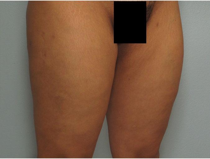 Dr. Diane Duncan liposuction after — Fort Collins, CO