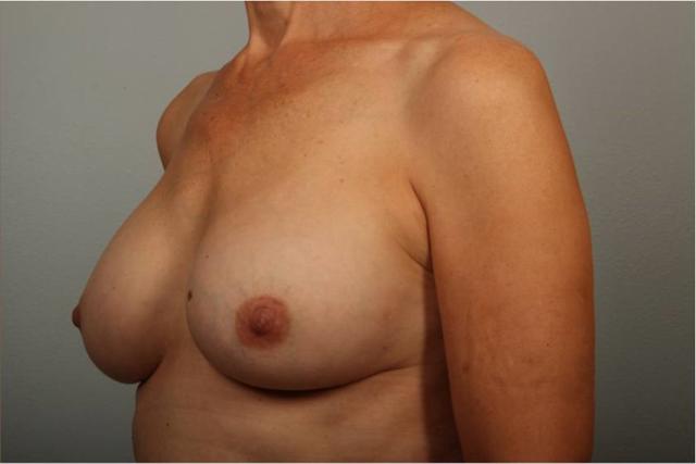 Breast Lift after at Dr. Diane Duncan in Fort Collins, CO