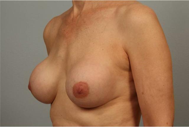 Breast Lift before at Dr. Diane Duncan in Fort Collins, CO