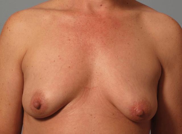 Breast Lift before at Dr. Diane Duncan in Fort Collins, CO
