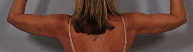 Arm Lift after at Dr. Diane Duncan in Fort Collins, CO