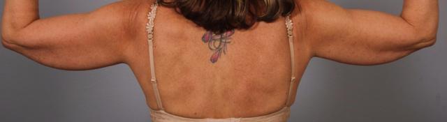 Arm Lift before at Dr. Diane Duncan in Fort Collins, CO