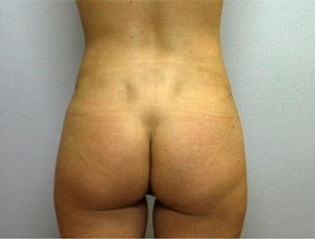 Dr. Diane Duncan liposuction after — Fort Collins, CO