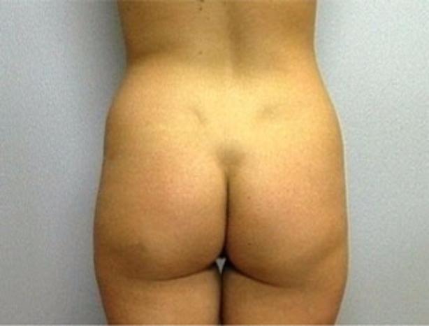 Liposuction before at Dr. Diane Duncan in Fort Collins, CO