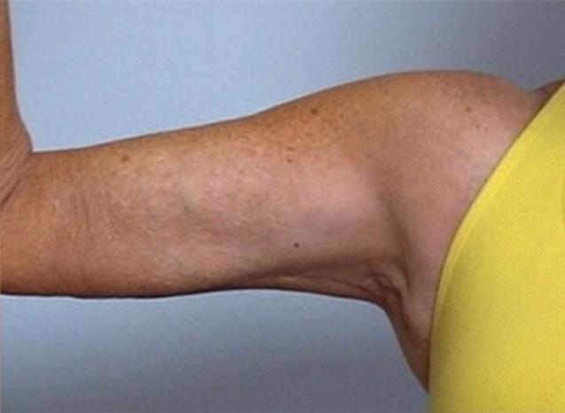 Dr. Diane Duncan arm lift after — Fort Collins, CO